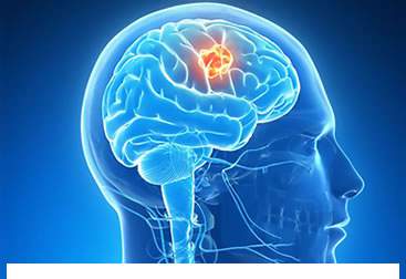 Beyin Tümörleri Cerrahisi
